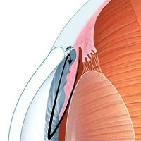 Open-Angle Glaucoma