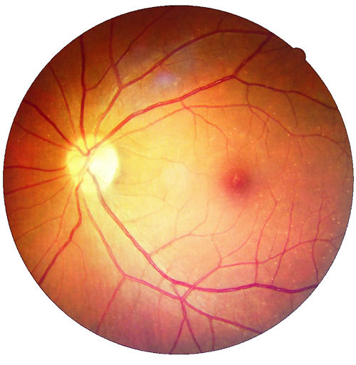 Diabetic Retinopathy Diabetic Retinopathy