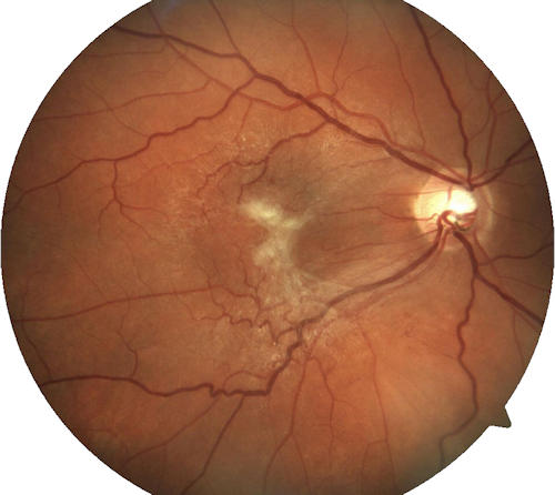 Epiretinal Membrane Epiretinal Membrane