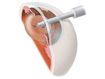 Cataract Treatment - Phaco Cataract Treatment - Phaco