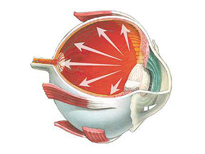 Glaucoma Glaucoma