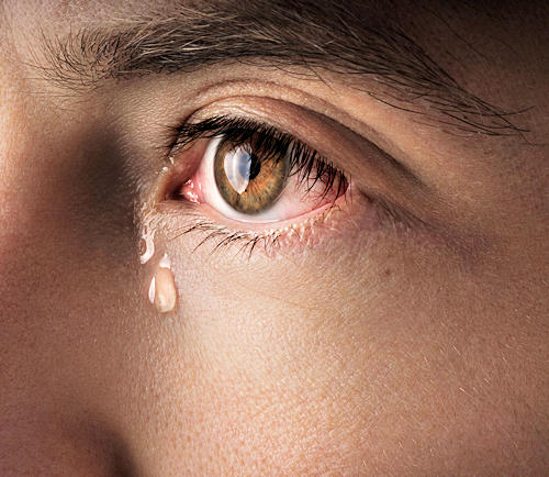Blocked Tear Duct Blocked Tear Duct