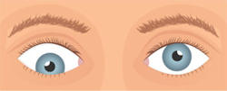 Downward Deviation of the Eye (Hypotropia)