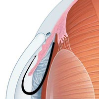 Closed-Angle Glaucoma