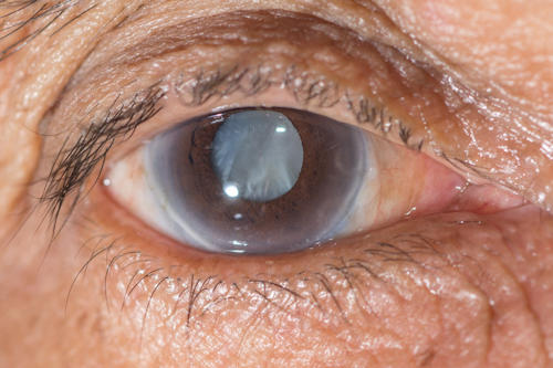 Cataract Cataract