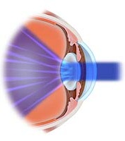 Cataract Vision
