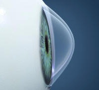 Keratoconus