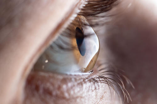 Keratoconus Keratoconus