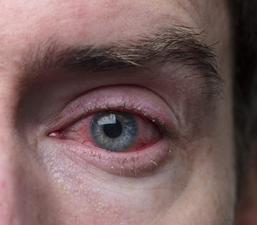 Conjunctivitis Conjunctivitis