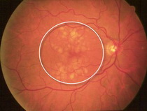 Dry Type Macular Degeneration