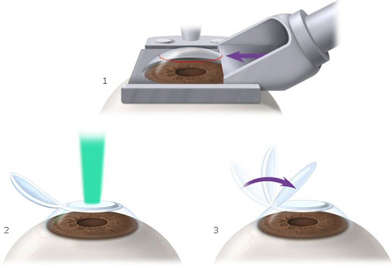 LASIK LASIK