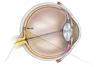 Macular Degeneration (Yellow Spot Disease) Macular Degeneration (Yellow Spot Disease)