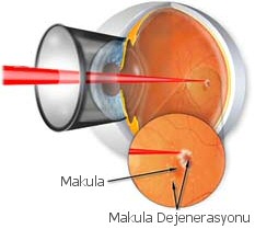 Macular Degeneration