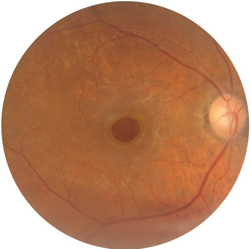 Macular Hole Macular Hole