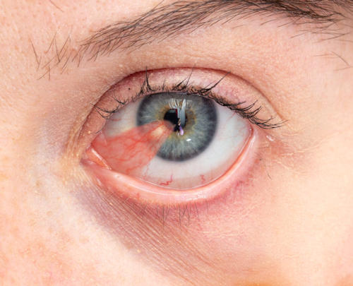 Pterygium Pterygium