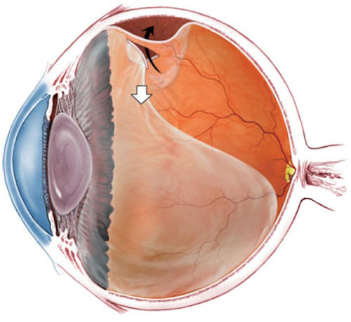 Retinal Detachment Retinal Detachment