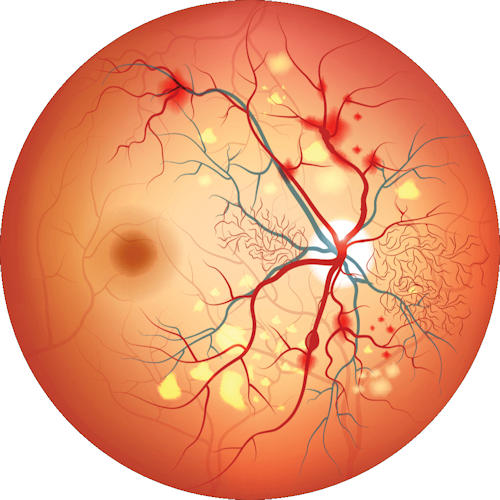 Retina Hastalıkları Retina Hastalıkları