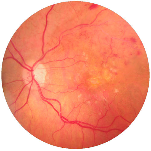 Retinal Vascular Occlusions Retinal Vascular Occlusions