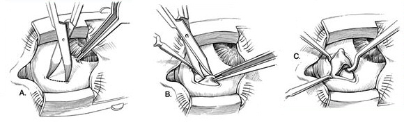 Strabismus Surgery Strabismus Surgery