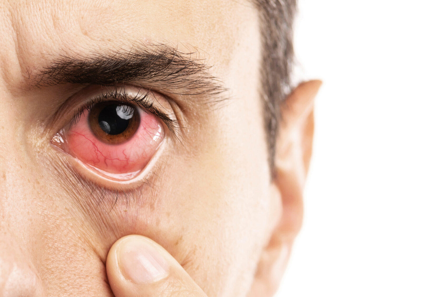 Uveitis Uveitis