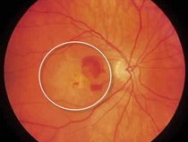 Wet Type Macular Degeneration