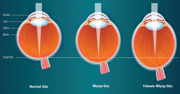 Myopia Myopia